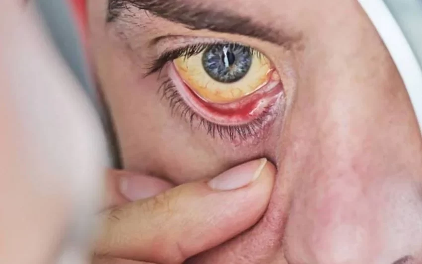  തളിപ്പറമ്പ പഞ്ചായത്തുകളുടെയും മുൻസിപ്പാലിറ്റികളെയും മഞ്ഞപ്പിത്തം അപ്ഡേറ്റ്